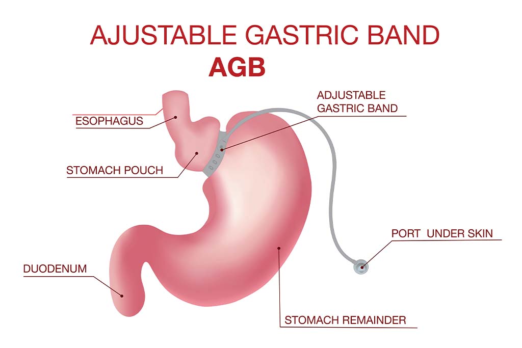 Ajustable Gastric Band (AGB) Diagram