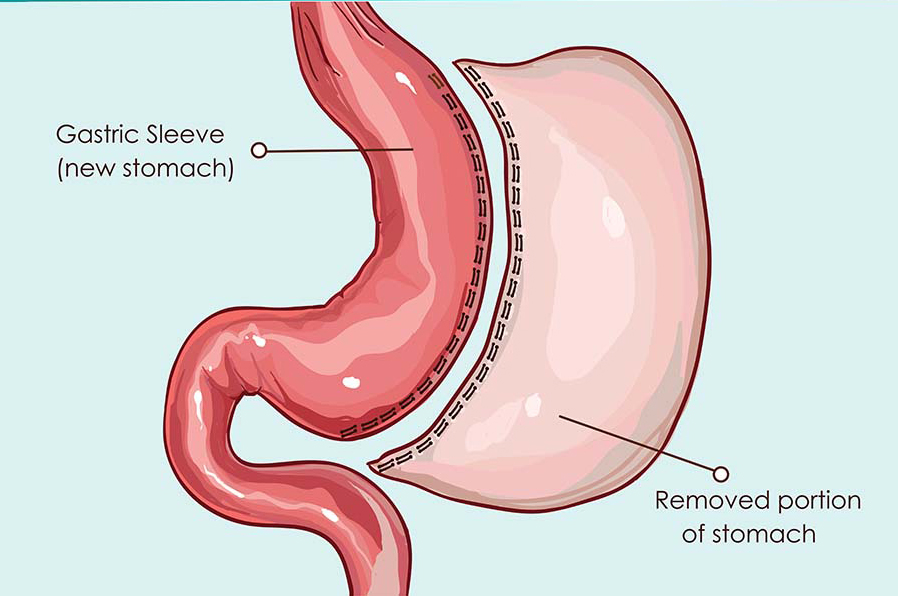 Vertical Sleeve Gastrectomy Diagram Illustration