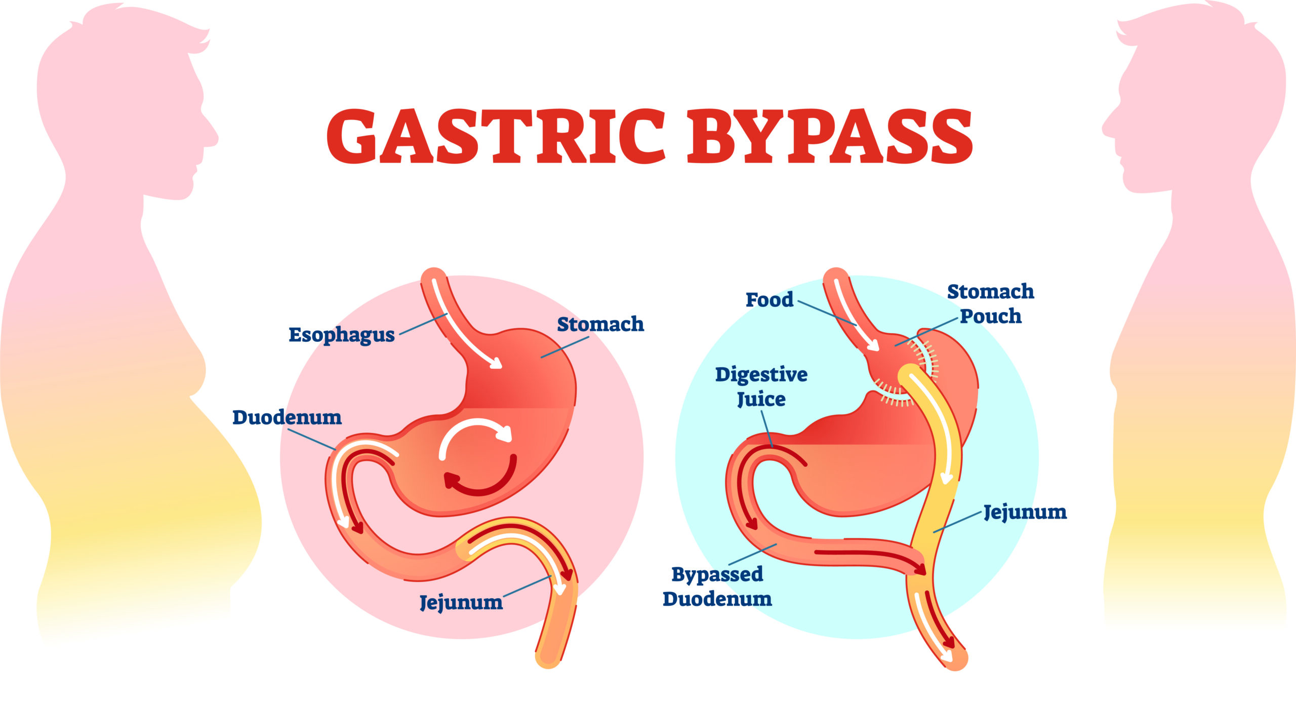 Gastric Bypass