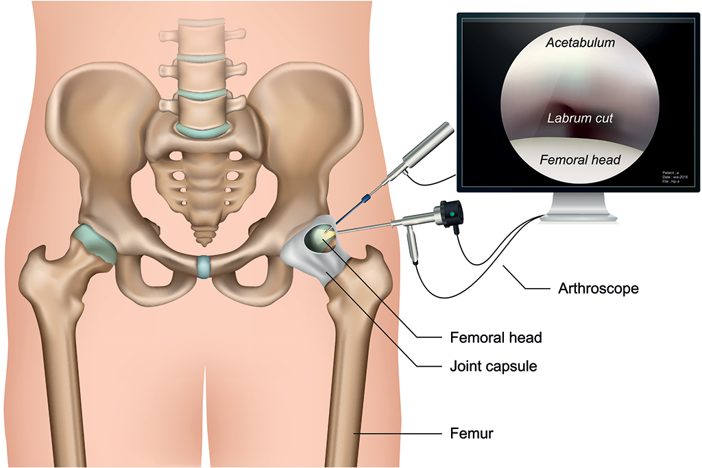 Hip arthroscopy illustration