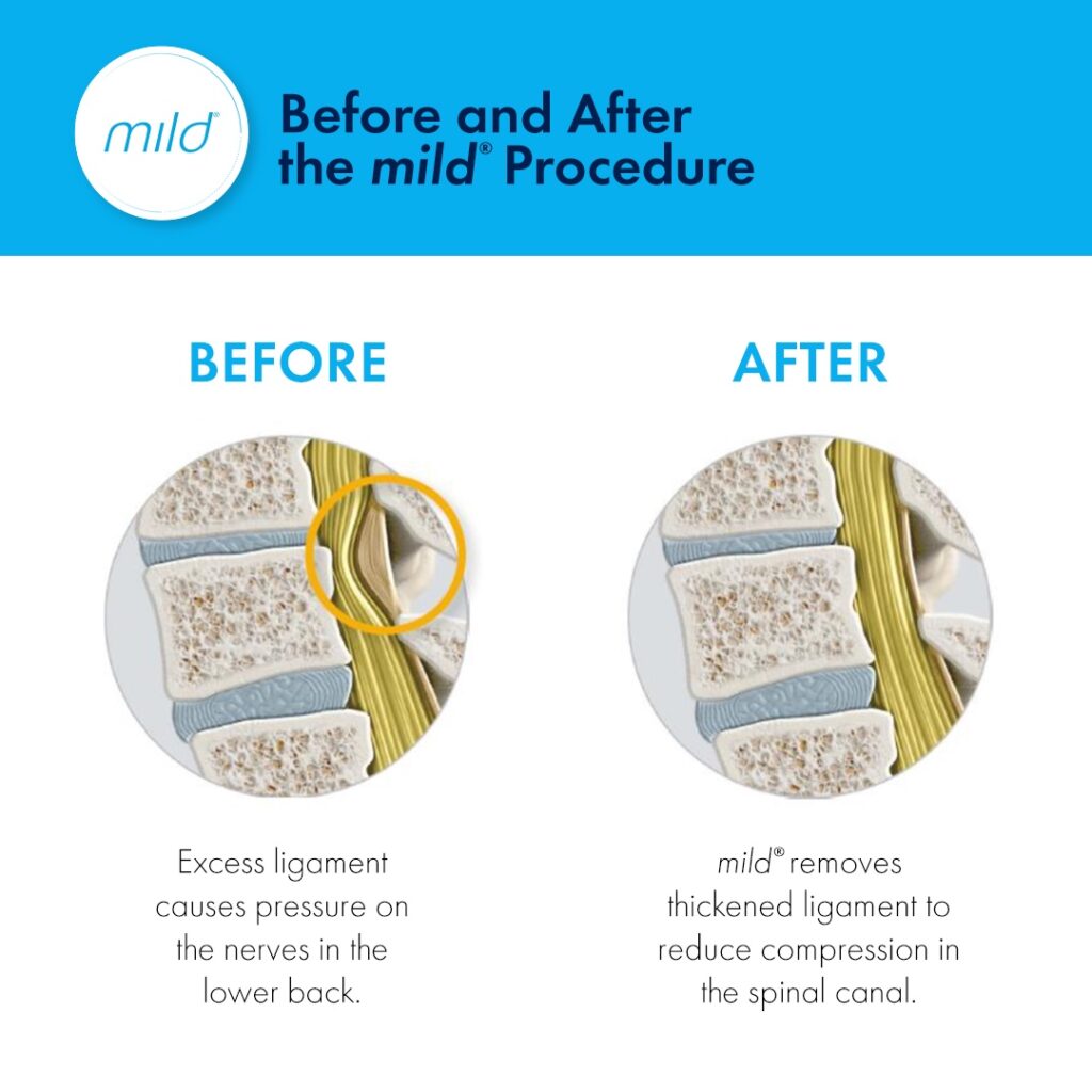 Before and after Mild procedure